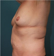 Breast Augmentation Before Photo by Marvin Shienbaum, MD; Brandon, FL - Case 31234