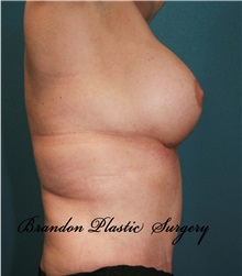 Breast Augmentation After Photo by Marvin Shienbaum, MD; Brandon, FL - Case 31234