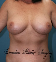 Breast Augmentation After Photo by Marvin Shienbaum, MD; Brandon, FL - Case 31235