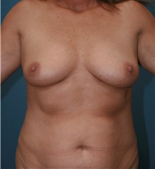 Breast Augmentation Before Photo by Marvin Shienbaum, MD; Brandon, FL - Case 31235