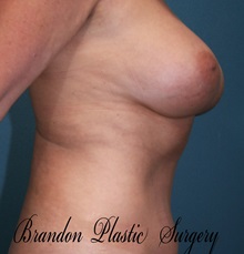 Breast Augmentation After Photo by Marvin Shienbaum, MD; Brandon, FL - Case 31235