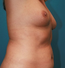 Breast Augmentation Before Photo by Marvin Shienbaum, MD; Brandon, FL - Case 31235