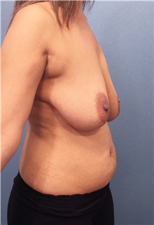Breast Lift Before Photo by Marvin Shienbaum, MD; Brandon, FL - Case 34604