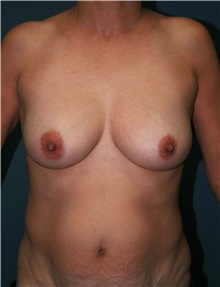 Breast Lift Before Photo by Marvin Shienbaum, MD; Brandon, FL - Case 34605