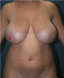 Breast Lift Before Photo by Marvin Shienbaum, MD; Brandon, FL - Case 34607