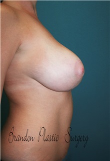 Breast Lift After Photo by Marvin Shienbaum, MD; Brandon, FL - Case 34607