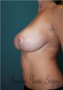 Breast Lift After Photo by Marvin Shienbaum, MD; Brandon, FL - Case 34607