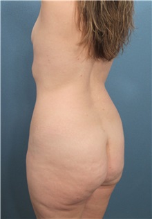 Tummy Tuck Before Photo by Marvin Shienbaum, MD; Brandon, FL - Case 34622