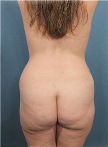 Tummy Tuck Before Photo by Marvin Shienbaum, MD; Brandon, FL - Case 34622