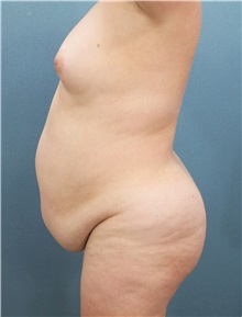 Tummy Tuck Before Photo by Marvin Shienbaum, MD; Brandon, FL - Case 34623