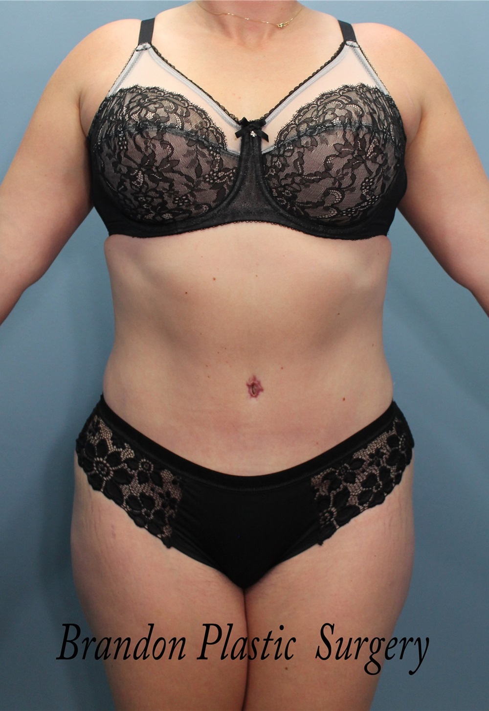 Tummy Tuck Before and After Photos by Marvin Shienbaum MD