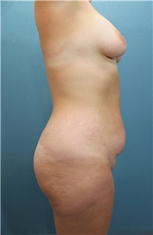 Tummy Tuck Before Photo by Marvin Shienbaum, MD; Brandon, FL - Case 34624