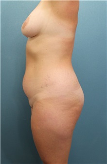 Tummy Tuck Before Photo by Marvin Shienbaum, MD; Brandon, FL - Case 34624