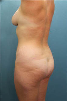 Tummy Tuck Before Photo by Marvin Shienbaum, MD; Brandon, FL - Case 34624