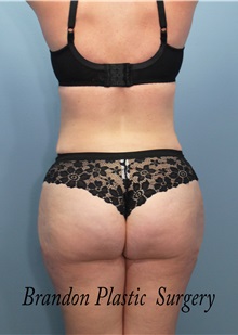 Tummy Tuck After Photo by Marvin Shienbaum, MD; Brandon, FL - Case 34624