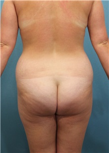 Tummy Tuck Before Photo by Marvin Shienbaum, MD; Brandon, FL - Case 34624