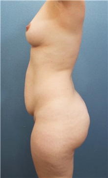 Tummy Tuck Before Photo by Marvin Shienbaum, MD; Brandon, FL - Case 34625