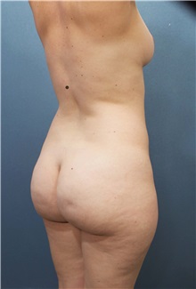 Tummy Tuck Before Photo by Marvin Shienbaum, MD; Brandon, FL - Case 34625