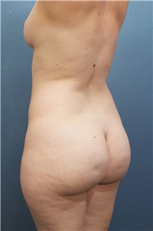 Tummy Tuck Before Photo by Marvin Shienbaum, MD; Brandon, FL - Case 34625