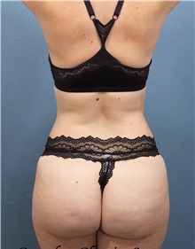 Tummy Tuck After Photo by Marvin Shienbaum, MD; Brandon, FL - Case 34625