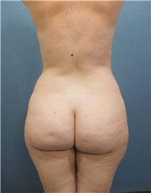 Tummy Tuck Before Photo by Marvin Shienbaum, MD; Brandon, FL - Case 34625