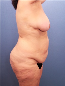 Tummy Tuck Before Photo by Marvin Shienbaum, MD; Brandon, FL - Case 34626