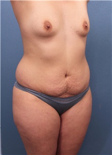 Tummy Tuck Before Photo by Marvin Shienbaum, MD; Brandon, FL - Case 34627