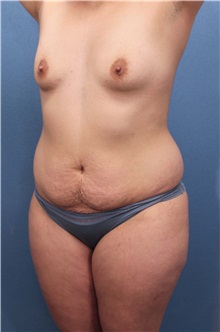 Tummy Tuck Before Photo by Marvin Shienbaum, MD; Brandon, FL - Case 34627