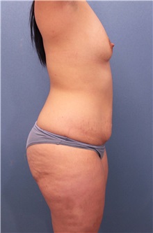 Tummy Tuck Before Photo by Marvin Shienbaum, MD; Brandon, FL - Case 34627