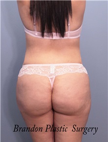 Tummy Tuck After Photo by Marvin Shienbaum, MD; Brandon, FL - Case 34627