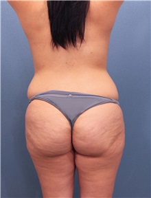 Tummy Tuck Before Photo by Marvin Shienbaum, MD; Brandon, FL - Case 34627