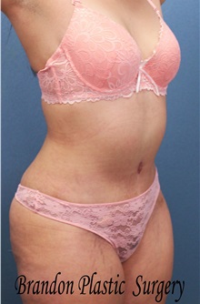 Tummy Tuck After Photo by Marvin Shienbaum, MD; Brandon, FL - Case 34628