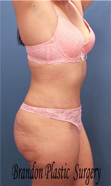 Tummy Tuck After Photo by Marvin Shienbaum, MD; Brandon, FL - Case 34628