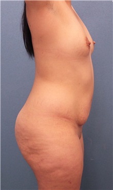 Tummy Tuck Before Photo by Marvin Shienbaum, MD; Brandon, FL - Case 34628