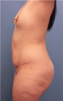 Tummy Tuck Before Photo by Marvin Shienbaum, MD; Brandon, FL - Case 34628