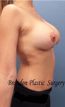 Breast Lift After Photo by Marvin Shienbaum, MD; Brandon, FL - Case 34713