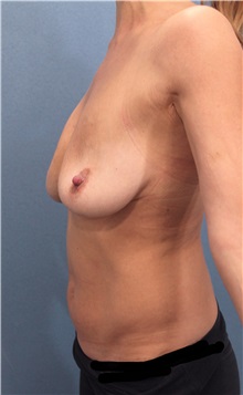 Breast Lift Before Photo by Marvin Shienbaum, MD; Brandon, FL - Case 34713