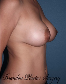 Breast Lift After Photo by Marvin Shienbaum, MD; Brandon, FL - Case 34715