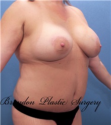 Breast Lift After Photo by Marvin Shienbaum, MD; Brandon, FL - Case 34716