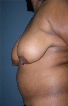 Breast Lift Before Photo by Marvin Shienbaum, MD; Brandon, FL - Case 34719