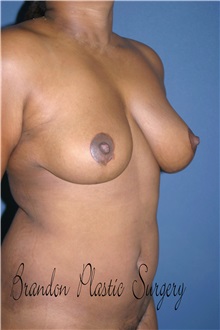 Breast Lift After Photo by Marvin Shienbaum, MD; Brandon, FL - Case 34719