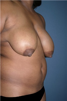 Breast Lift Before Photo by Marvin Shienbaum, MD; Brandon, FL - Case 34719