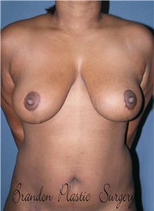 Breast Lift After Photo by Marvin Shienbaum, MD; Brandon, FL - Case 34719