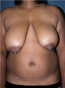 Breast Lift Before Photo by Marvin Shienbaum, MD; Brandon, FL - Case 34719