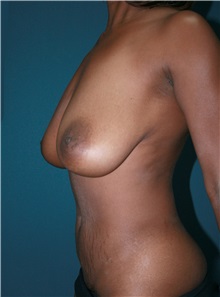 Breast Lift Before Photo by Marvin Shienbaum, MD; Brandon, FL - Case 34720
