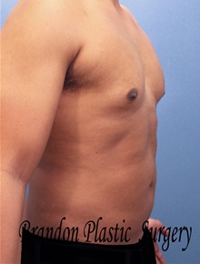 Male Breast Reduction After Photo by Marvin Shienbaum, MD; Brandon, FL - Case 34846