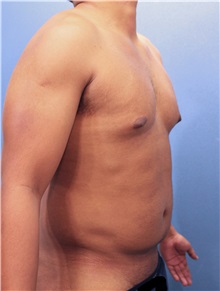 Male Breast Reduction Before Photo by Marvin Shienbaum, MD; Brandon, FL - Case 34846