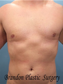 Male Breast Reduction After Photo by Marvin Shienbaum, MD; Brandon, FL - Case 34847