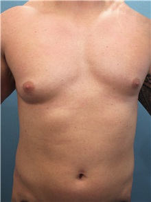 Male Breast Reduction Before Photo by Marvin Shienbaum, MD; Brandon, FL - Case 34847