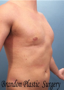 Male Breast Reduction After Photo by Marvin Shienbaum, MD; Brandon, FL - Case 34847